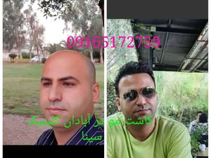 تکنیک کاشت مو به روش Super FUE در آبادان