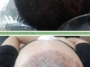 آموزش دوره های مزوتراپی مو در اکباتان