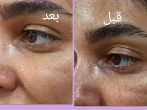 آموزش دوره های میکرونیدلینگ در اکباتان