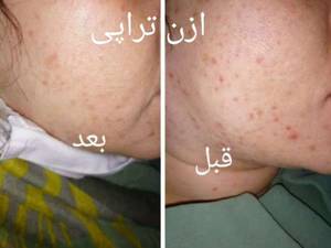 انجام اوزون تراپی در اکباتان تهران