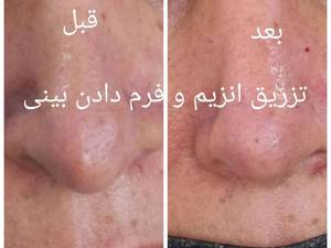 کوچک کردن بینی با تزریق در تهران