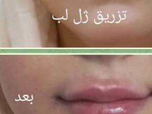 تزریق ژل لب در اکباتان
