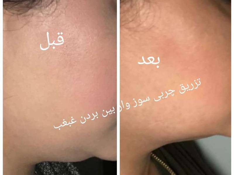 هزینه از بین بردن غبغب در تهران
