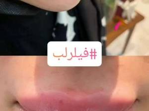 قیمت بوتاکس صورت در تبریز