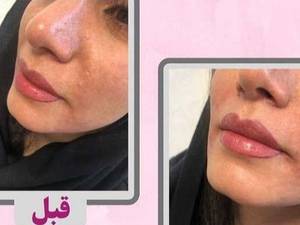 مرکز رفع خط خنده در اصفهان
