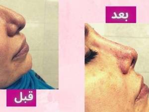 لیفت بینی با نخ در اصفهان
