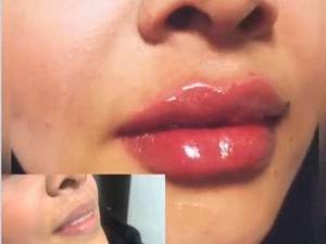 تزریق ژل لب روسی در اصفهان