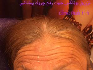 بوتاکس جهت لیفت ابرو در رشت