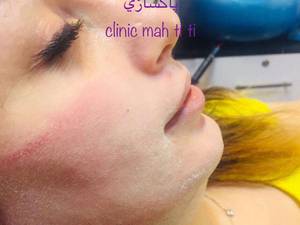 میکرودرم ابریژن در رشت