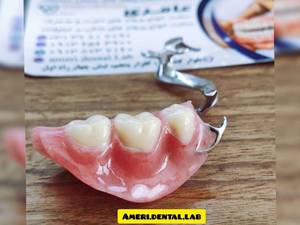 پروتز کروم کبالت اصفهان