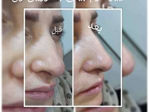 تغییر فرم بینی با تزریق ژل در تهران