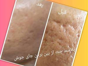 انجام پلاسما جت به صورت حرفه ای در تهران