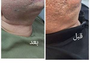 انجام پلاسما جت به صورت حرفه ای در تهران