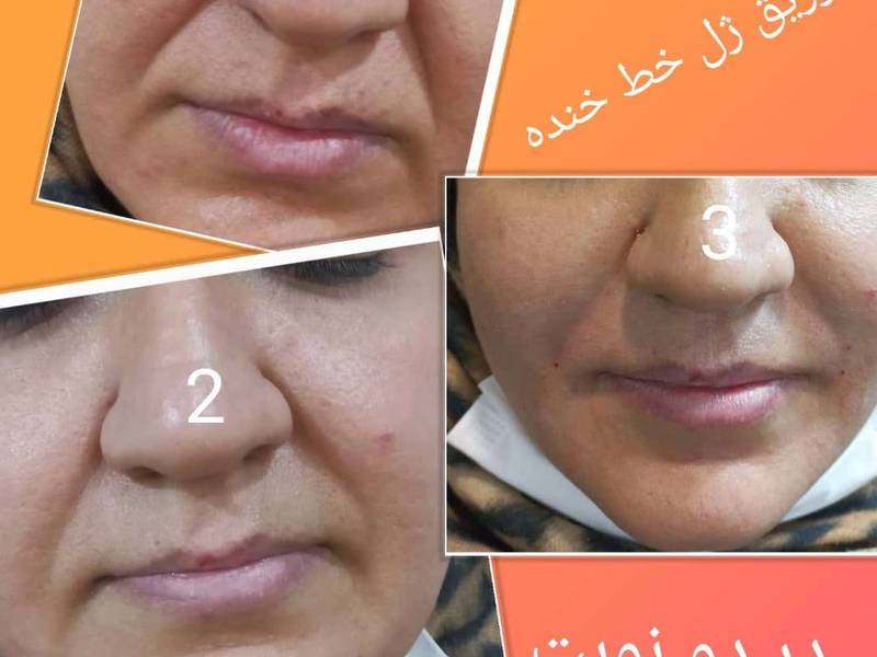 تزریق ژل خط خنده در تهران