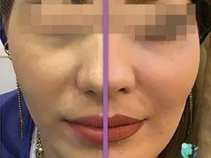 تزریق چربی گونه