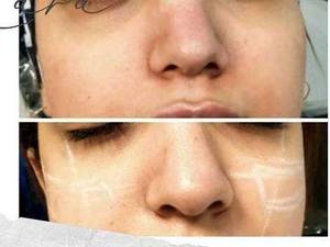 کوچک کردن بینی بدون جراحی در بوشهر