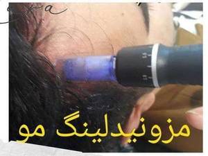 انجام مزوتراپی مو در بوشهر