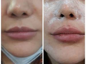 تزریق ژل لب مدل طبیعی در تهران