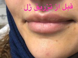 قیمت تزریق ژل لب در اصفهان