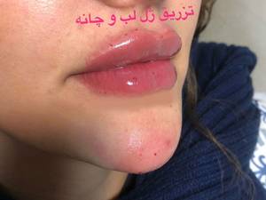 قیمت تزریق ژل لب در اصفهان