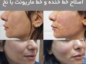 اصلاح خط خنده و ماریونت با نخ