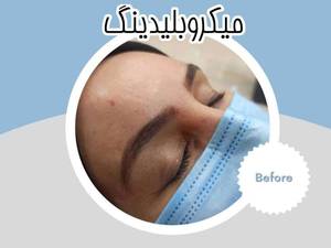 میکرو بلیدینگ  ابرو در بوشهر