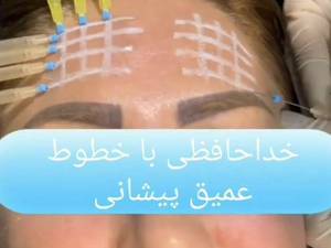 کار گذاری نخ کلاژن ساز در یزد