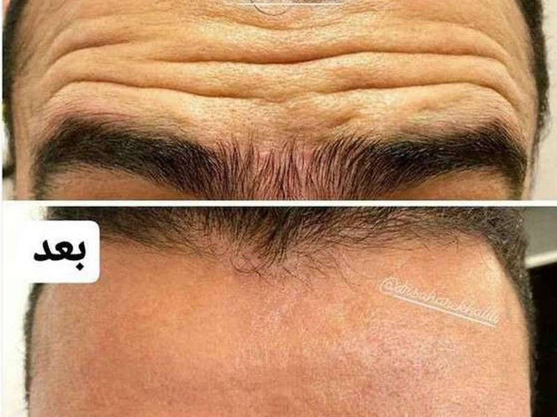 انجام بوتاکس برای رفع چین و چروک در یزد