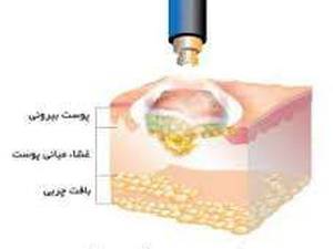 سرمادرمانی یا کرایوتراپی در لنگرود