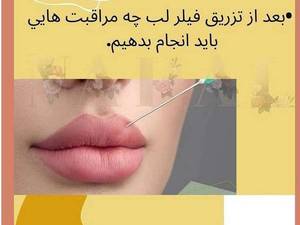 مراقبت های بعد از فیلر