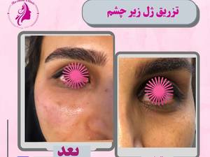 تزريق ژل زير چشم