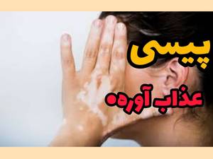 درمان پیسی