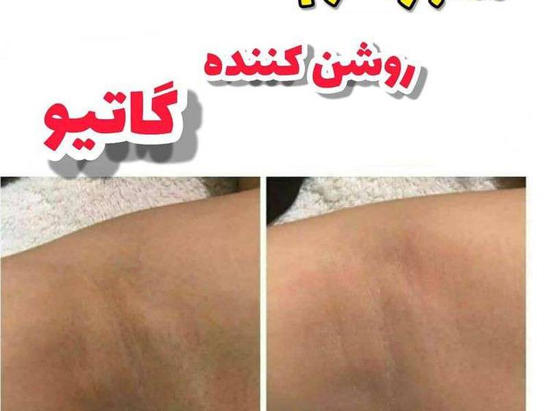 رفع تیرگی پوستی