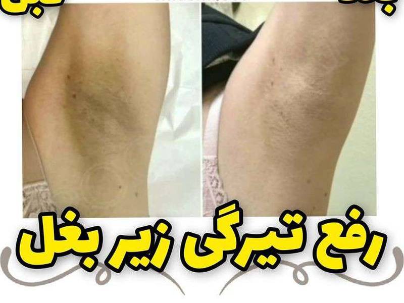 با تیرگی هات خداحافظی کن