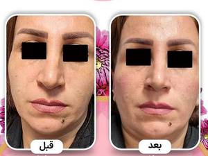 برطرف کردن افت گونه در بوشهر