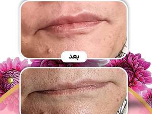 تزریق فیلر آلاینا آلمان در بوشهر