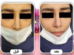 تزریق فیلر بینی به صورت حرفه ای در بوشهر