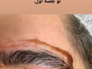 آموزش و خدمات فیبروز میکرو بلیندینگ در البرز