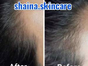بهترین مرکز مزوتراپی مو در ارومیه