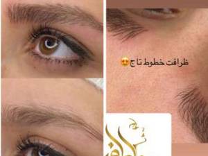 اجرای میکروبلیدینگ به روش فیبروز