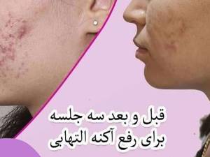 رفع  آکنه  التهابی  در ارومیه