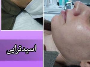 اسید تراپی پوست  در ارومیه