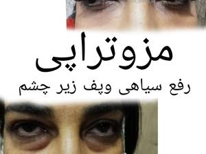 رفع سیاهی زیرچشم دربوشهر