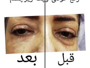 رفع گودی وپف زیر چشم دربوشهر