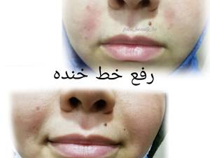 رفع خط خنده در بوشهر
