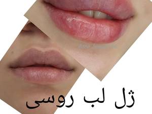 تزریق  ژل لب روسی  در بوشهر