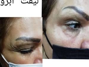 لیفت حرفه ای  ابرو در بوشهر