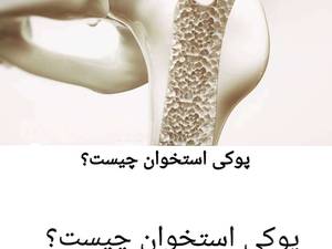 پوکی استخوان علت و درمان