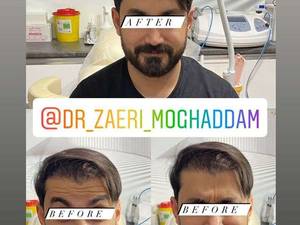 تزریق بوتاکس درلاهیجان