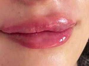 تزریق  ژل لب مدل روسی در لاهیجان